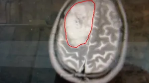 Top view of the tumor.