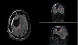 MRI scan of Gary after the operation.