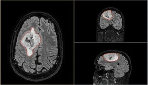 MRI scan of Gary before the operation.