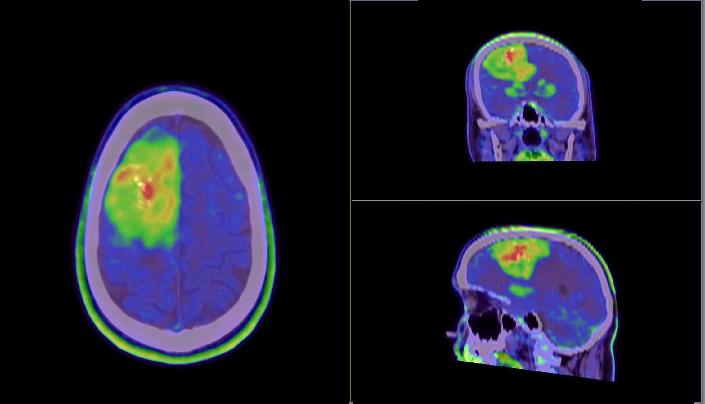 PET Scan of the tumour.
