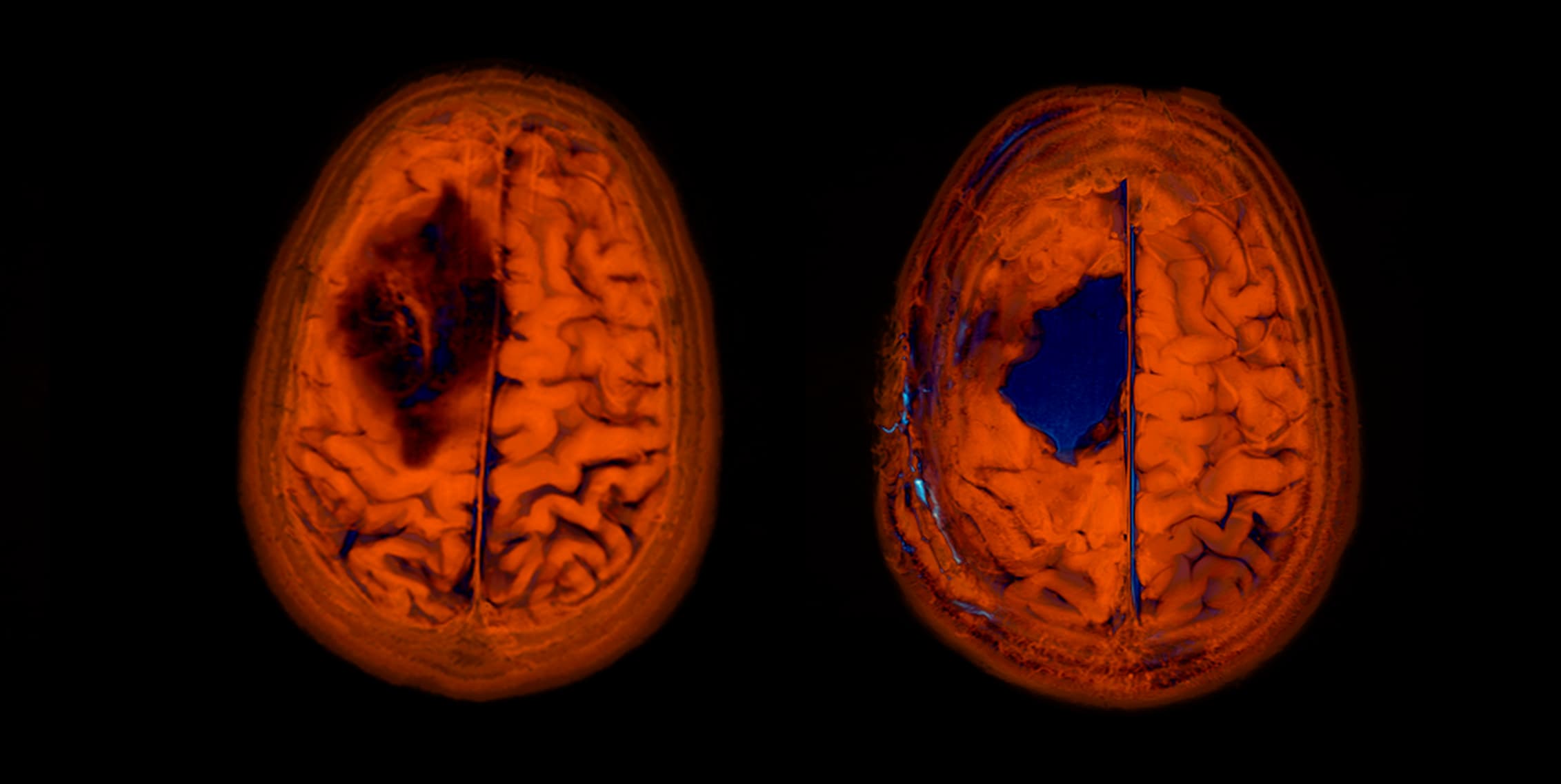Comparing imaging before / after for my brain